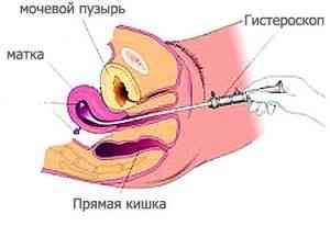 Последствия гистероскопии матки